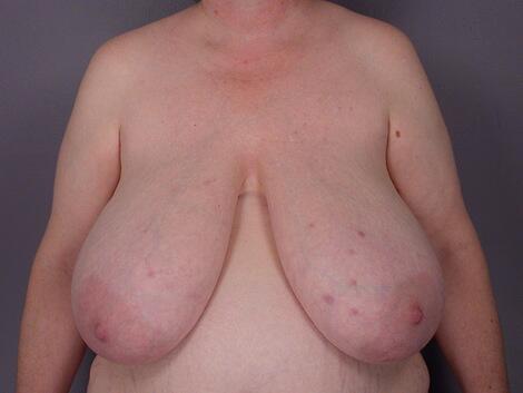 Breast Reduction (for Women) Before & After Image