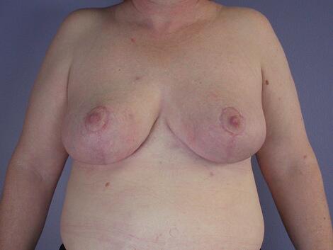 Breast Reduction (for Women) Before & After Image