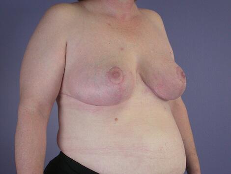 Breast Reduction (for Women) Before & After Image