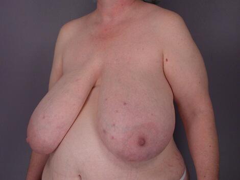 Breast Reduction (for Women) Before & After Image