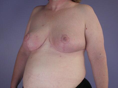 Breast Reduction (for Women) Before & After Image