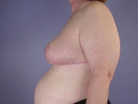 Breast Reduction (for Women) Before & After Image