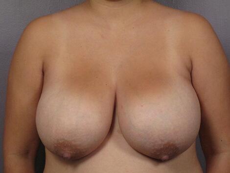 Breast Reduction (for Women) Before & After Image