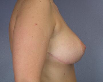 Breast Reduction (for Women) Before & After Image