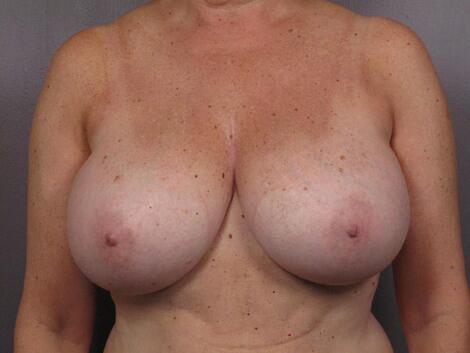 Breast Reduction (for Women) Before & After Image