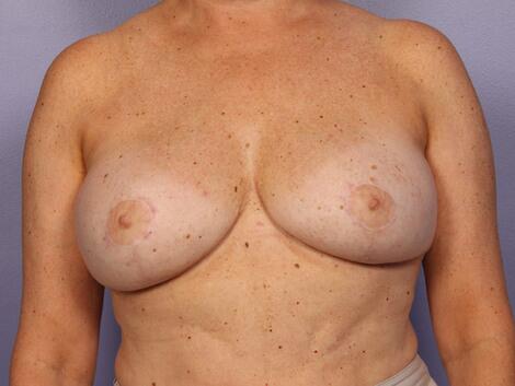 Breast Reduction (for Women) Before & After Image