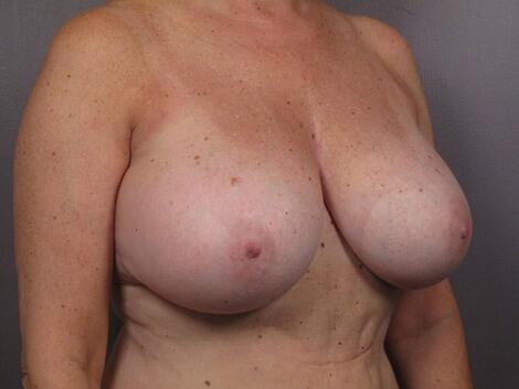 Breast Reduction (for Women) Before & After Image