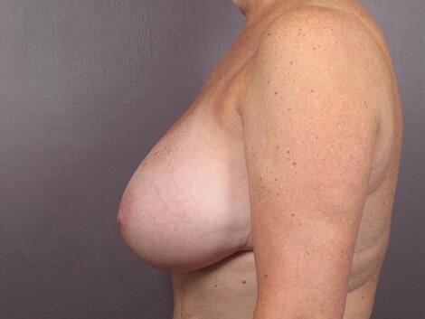 Breast Reduction (for Women) Before & After Image