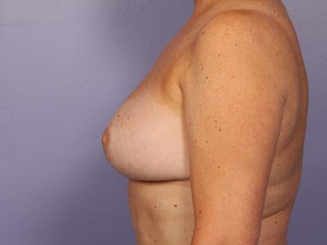 Breast Reduction (for Women) Before & After Image