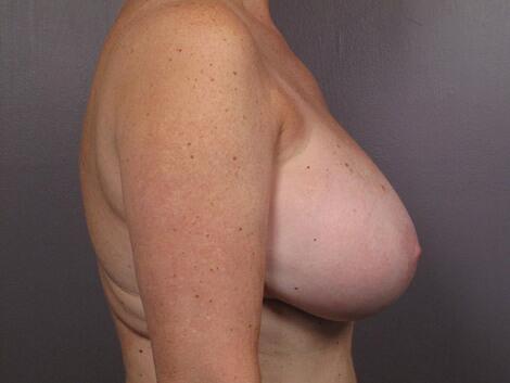 Breast Reduction (for Women) Before & After Image