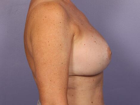 Breast Reduction (for Women) Before & After Image