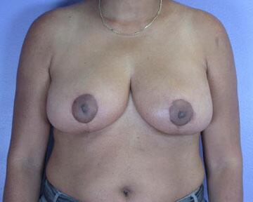 Breast Reduction (for Women) Before & After Image