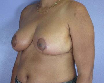 Breast Reduction (for Women) Before & After Image