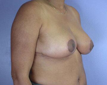 Breast Reduction (for Women) Before & After Image