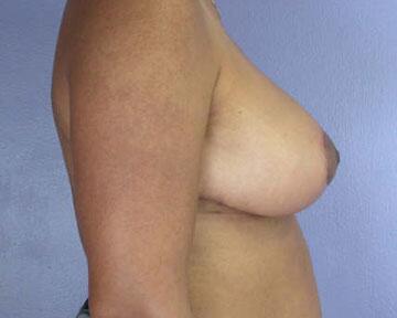 Breast Reduction (for Women) Before & After Image