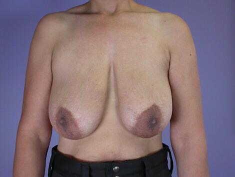 Breast Reduction (for Women) Before & After Image