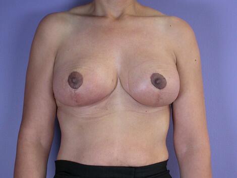 Breast Reduction (for Women) Before & After Image