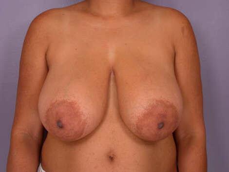 Breast Reduction (for Women) Before & After Image