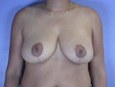 Breast Reduction (for Women) Before & After Image