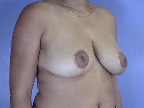 Breast Reduction (for Women) Before & After Image