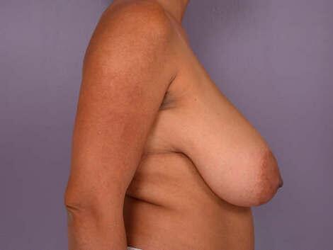 Breast Reduction (for Women) Before & After Image