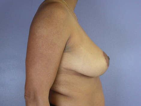 Breast Reduction (for Women) Before & After Image