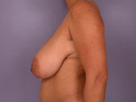 Breast Reduction (for Women) Before & After Image