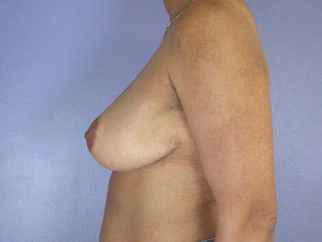 Breast Reduction (for Women) Before & After Image