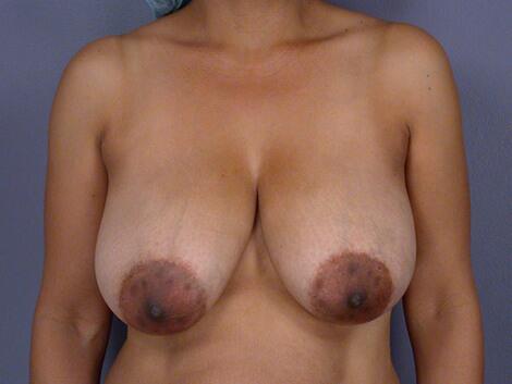 Breast Reduction (for Women) Before & After Image