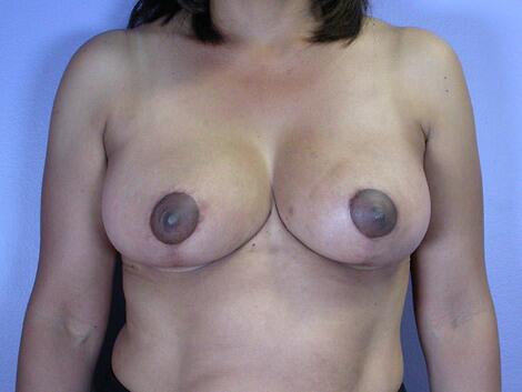 Breast Reduction (for Women) Before & After Image