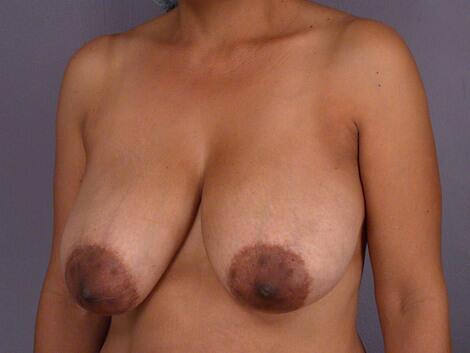 Breast Reduction (for Women) Before & After Image