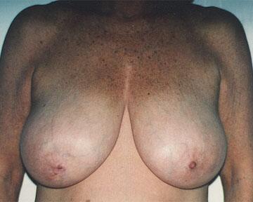 Breast Reduction (for Women) Before & After Image