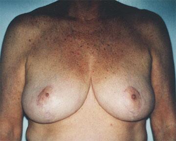 Breast Reduction (for Women) Before & After Image