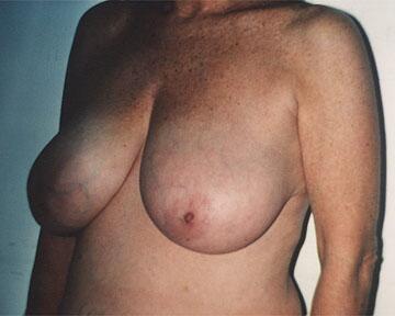 Breast Reduction (for Women) Before & After Image