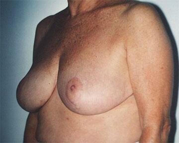 Breast Reduction (for Women) Before & After Image