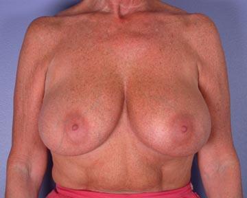 Breast Reduction (for Women) Before & After Image