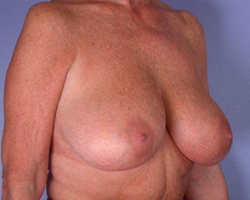 Breast Reduction (for Women) Before & After Image