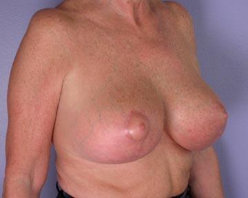 Breast Reduction (for Women) Before & After Image