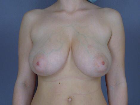 Breast Reduction (for Women) Before & After Image