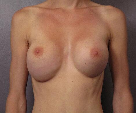 Breast Reduction (for Women) Before & After Image