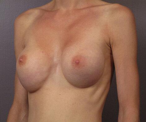 Breast Reduction (for Women) Before & After Image