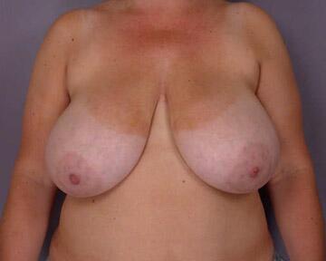 Breast Reduction (for Women) Before & After Image