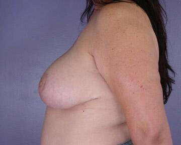 Breast Reduction (for Women) Before & After Image