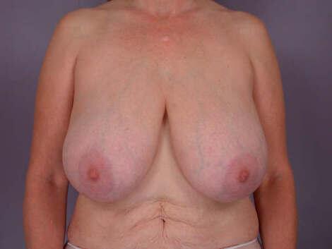 Breast Reduction (for Women) Before & After Image