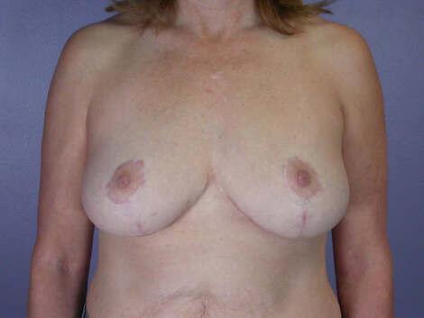 Breast Reduction (for Women) Before & After Image