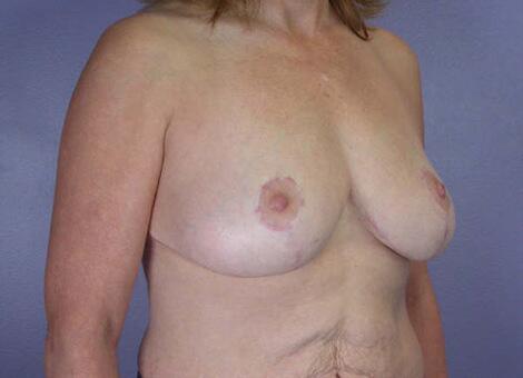 Breast Reduction (for Women) Before & After Image