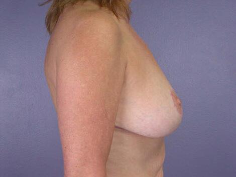 Breast Reduction (for Women) Before & After Image