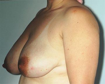 Breast Reduction (for Women) Before & After Image