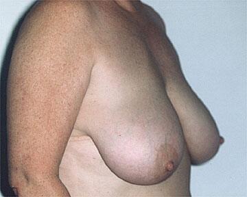 Breast Reduction (for Women) Before & After Image