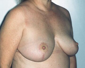 Breast Reduction (for Women) Before & After Image